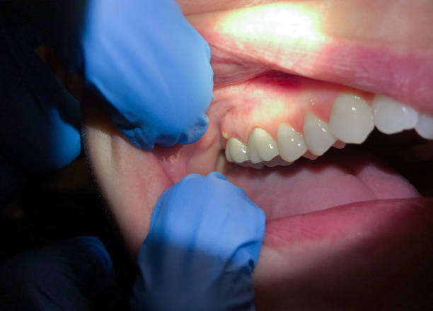 Best Emergency Tooth Extraction in Palm River Clair Mel, FL